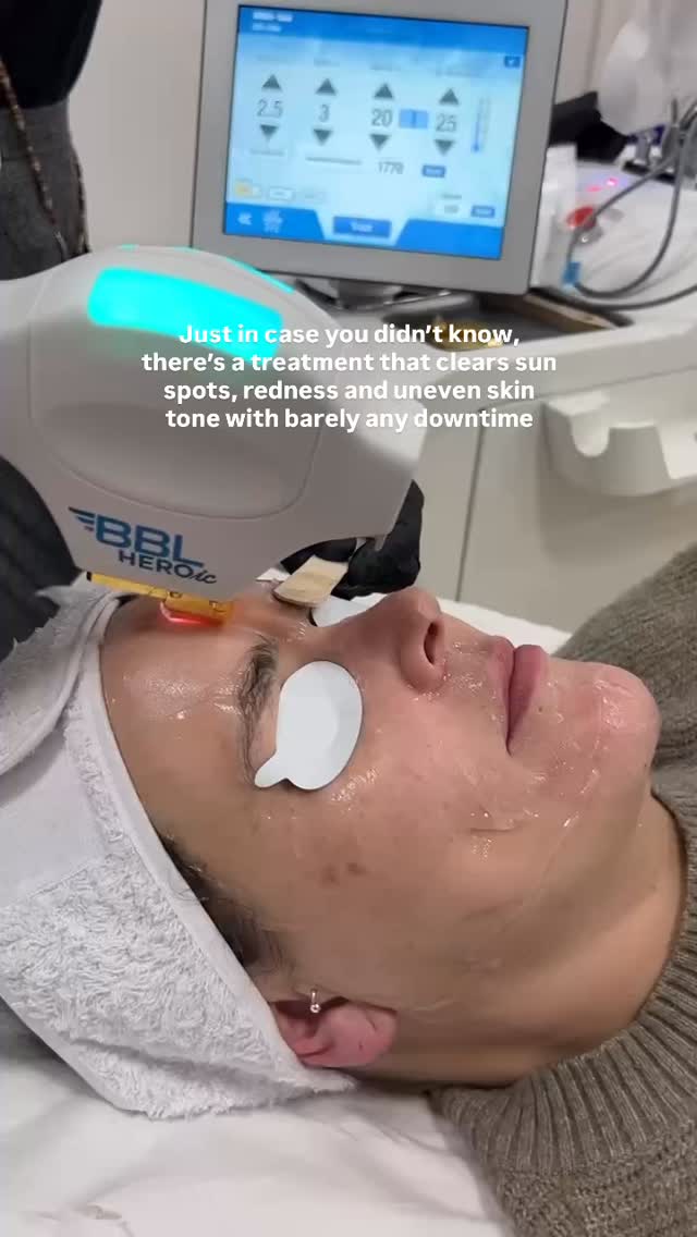One treatment, so many fixes, barely any downtime. BBL HEROic is a bit of an overachiever ✨️
Here’s how it works 👇🏼
BBL HEROic sends powerful broadband light into the skin, where it’s absorbed by the excess pigment and the redness sitting beneath the surface. That energy breaks it down, so your body can naturally clear it away, revealing clearer, more even skin underneath. It’s the same science as IPL, taken to a stronger, more precise level, which is where the HEROic part comes in.
It’s brilliant for:
✨ Fading sun spots and age spots
✨ Calming redness, rosacea and flushing
✨ Clearing broken capillaries and vascular lesions
✨ Evening out pigmentation and uneven tone
✨ Restoring overall brightness and radiance
It also works beautifully across the face, neck, chest and hands, wherever sun damage and redness tend to show. So whether it’s stubborn sun spots, persistent redness, or simply a complexion that’s lost its clarity, BBL HEROic makes a real difference.
Most people need a short course to see the full effect, usually a few sessions spaced a few weeks apart, with barely any downtime in between. You might notice a little warmth or some darkening of the spots at first, but this settles quickly as the skin clears.
If you’re ready to invest in clearer, brighter skin, DM the word “BBL” to learn more or book a consultation via the link in our bio. Your future skin will thank you ✨