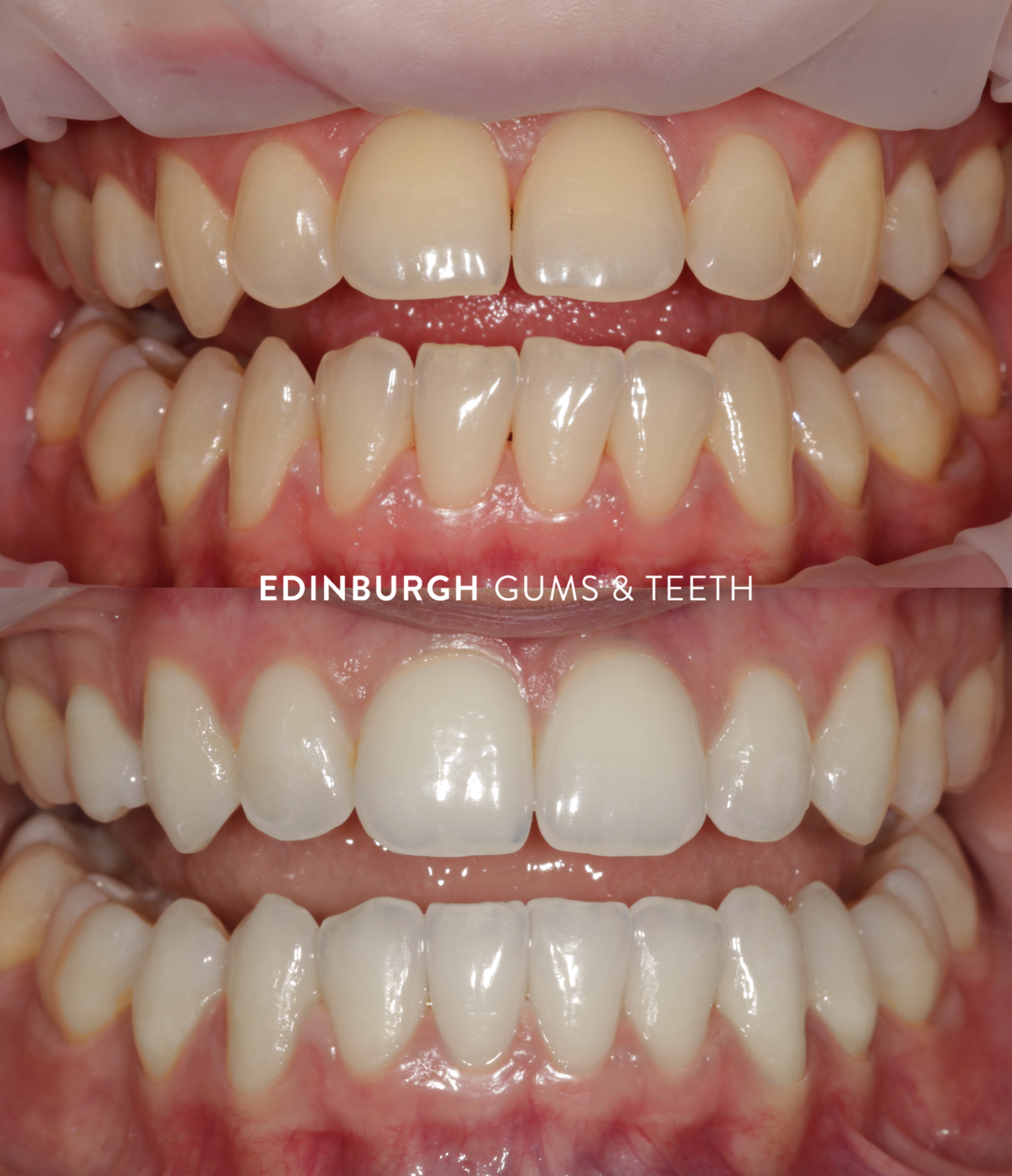 A little patience, a personalised treatment plan, and incredible results. Ready to see what Invisalign could do for your smile?
Book your FREE consultation and 3D smile scan today. 🦷
#Invisalign #SmileTransformation #beforeandafter