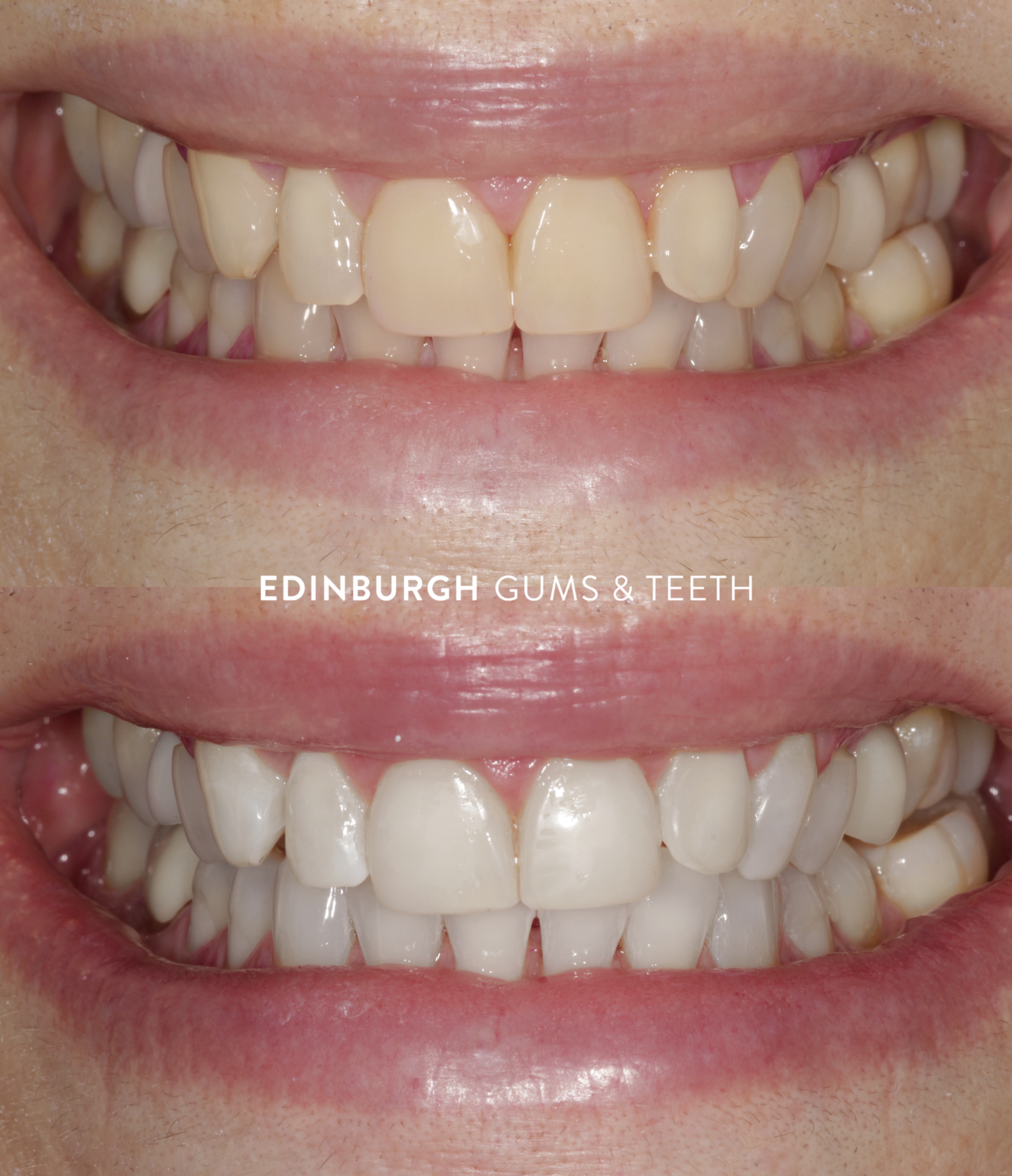 ✨ Brighter smile with our Philips Zoom in chair whitening treatment, carried out by our wonderful hygienist, Karen Beverage.
Want even better, longer lasting results? For just £55 extra, you can upgrade to our whitening package, including your in chair treatment plus home whitening syringes to keep your smile looking brighter for longer.
💙 Philips Zoom in chair whitening: £495
💙 Philips Zoom in chair whitening + home whitening top ups: £550
If you’ve been thinking about whitening your teeth, this is the perfect time to treat yourself.
📩 Send us a DM to book your consultation or find out more.
#TeethWhitening #PhilipsZoom #EdinburghDentist #SmileMakeover